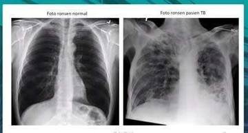 Stigma Klenik Masih Hambat Pengobatan TBC di Belu