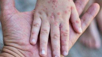 Kenali Perbedaan Cacar Monyet Dengan Cacar Air