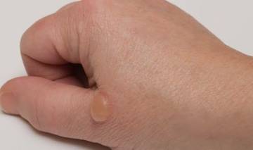 Penyebab Kulit Melepuh Serta Pengobatannya