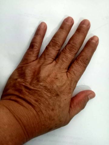 Kulit Tangan Keriput Merupakan Tanda Penuaan 