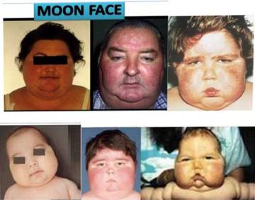 Mengenal Moon Face, Penyebab, Gejala dan  Cara Penyembuhannya